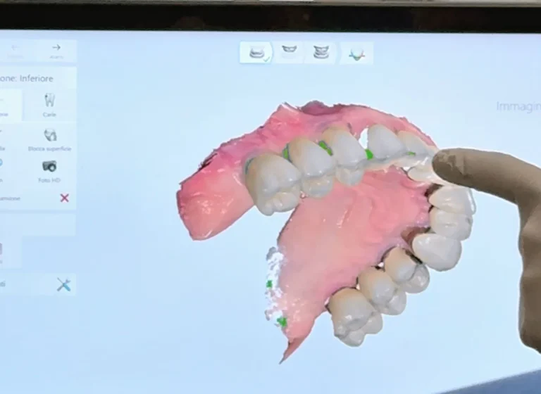 Blog 1 Quanto dura un impianto dentale