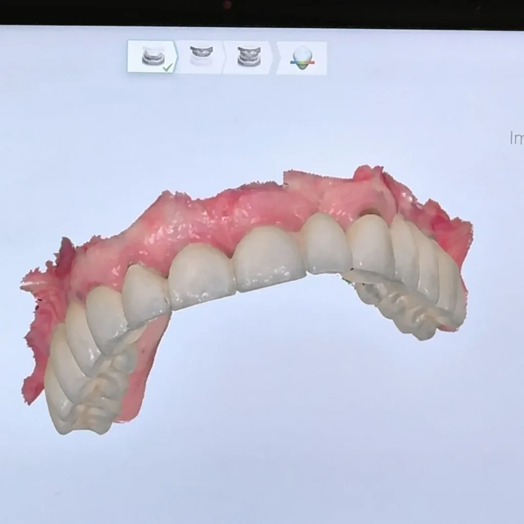Endodonzia 1 devitalizzazione dente a Busca Cuneo
