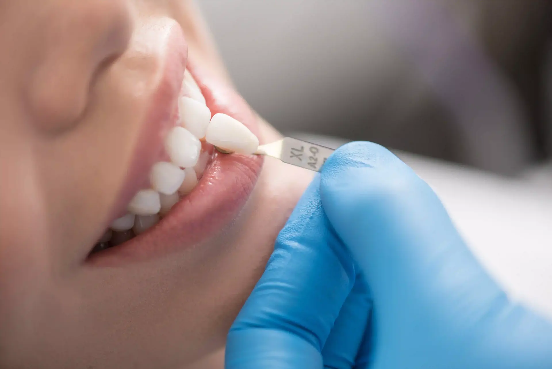 Differenza tra faccette dentali e corone