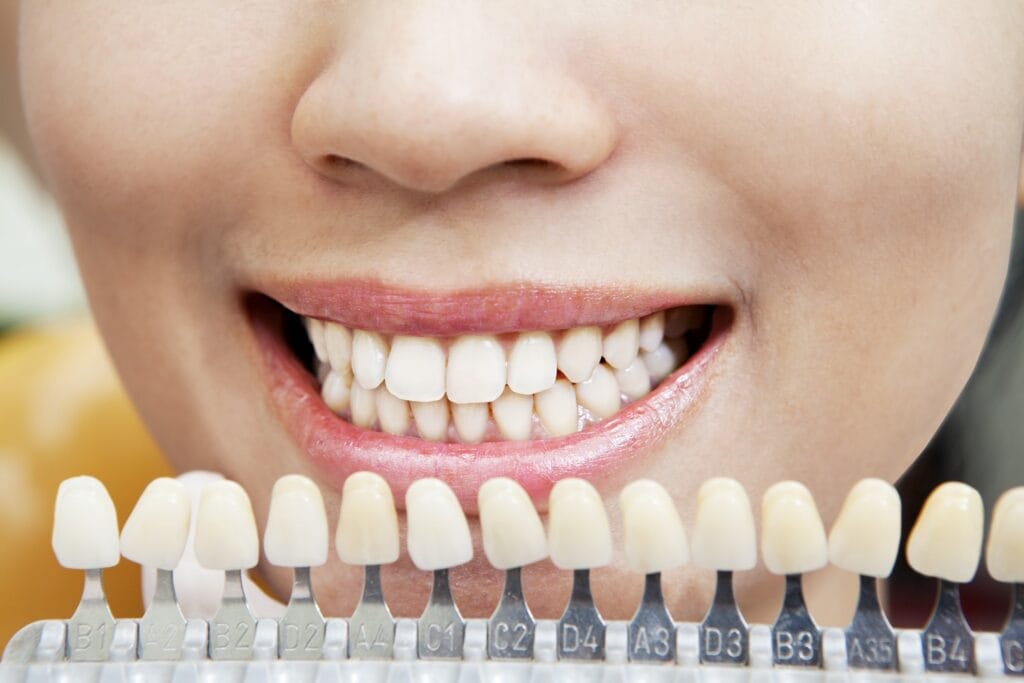 Estetica del sorriso: il tuo sorriso è importante, per te e per noi! 1 Faccette dentali per migliorare il sorriso