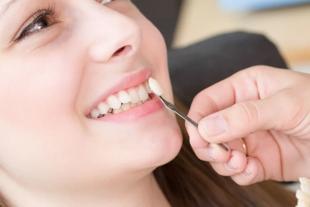 Faccette Dentali 1 faccette dentali a Busca Cuneo