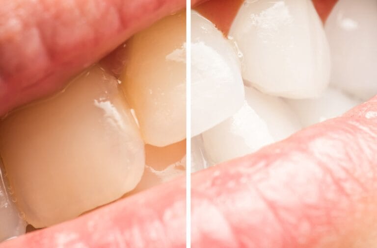 Blog 11 Come prevenire i denti gialli