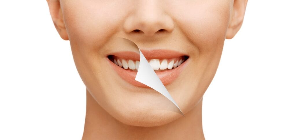 Sbiancamento dentale: falsi miti e leggende da sfatare 5 Sbiancamento dentale prima e dopo