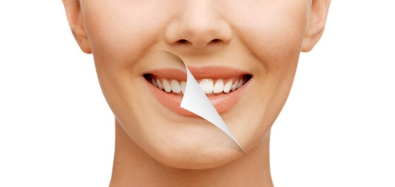 Blog 10 Sbiancamento dentale prima e dopo