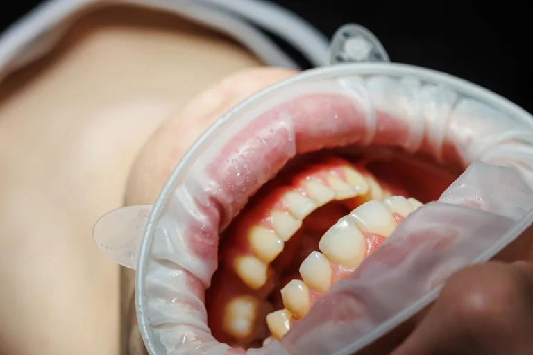 Sintomi più comuni della parodontite