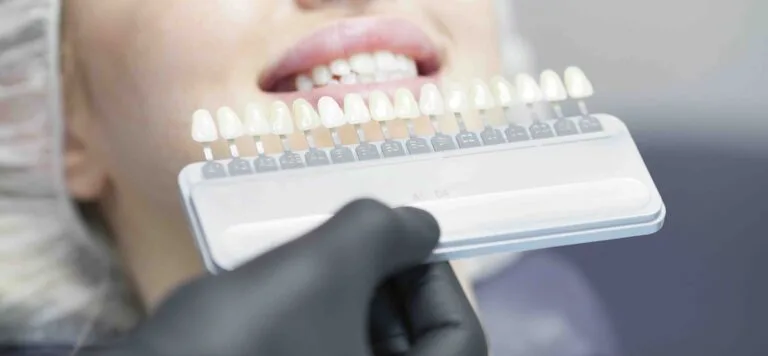 Le faccette dentali si rovinano con il tempo Le faccette dentali si rovinano con il tempo