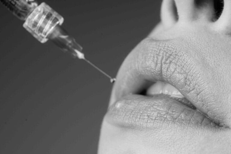 Filler labbra a Busca Cuneo