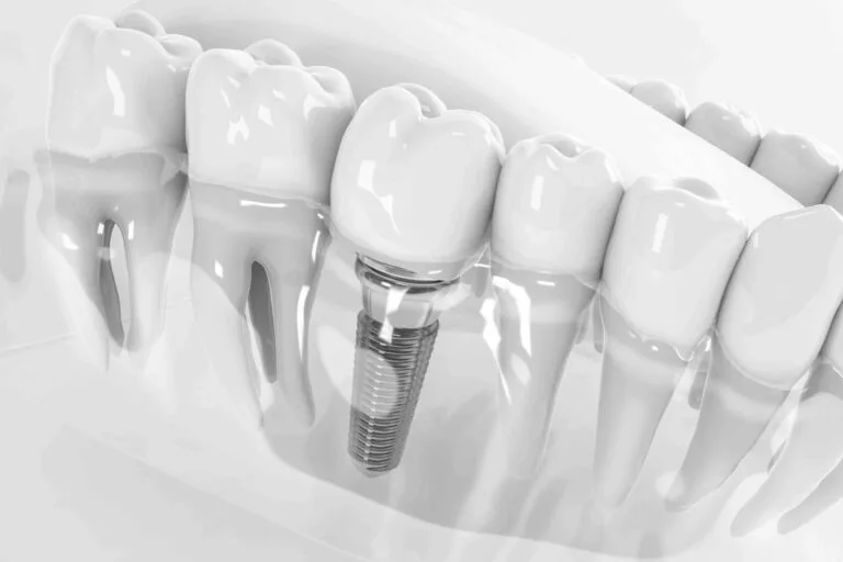 Impianto dentale a Busca Cuneo Impianto dentale a Busca Cuneo