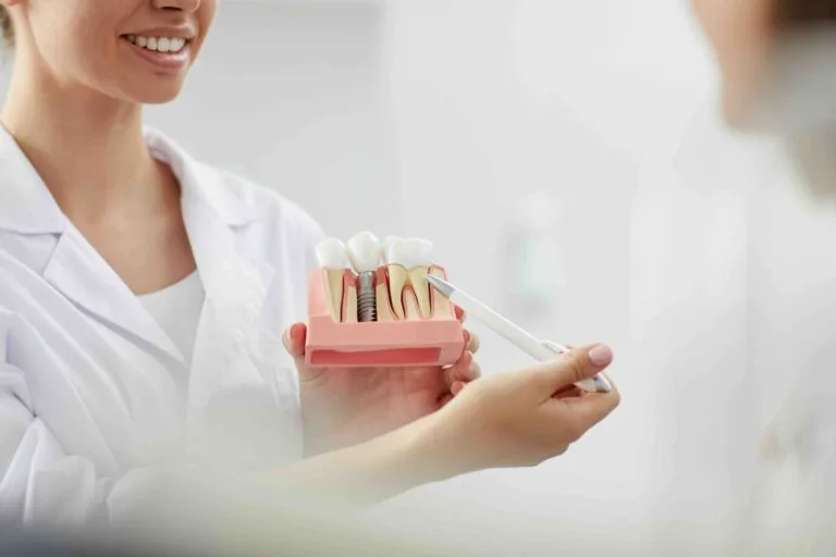 Cosa fare se un impianto dentale cade Cosa fare se un impianto dentale cade