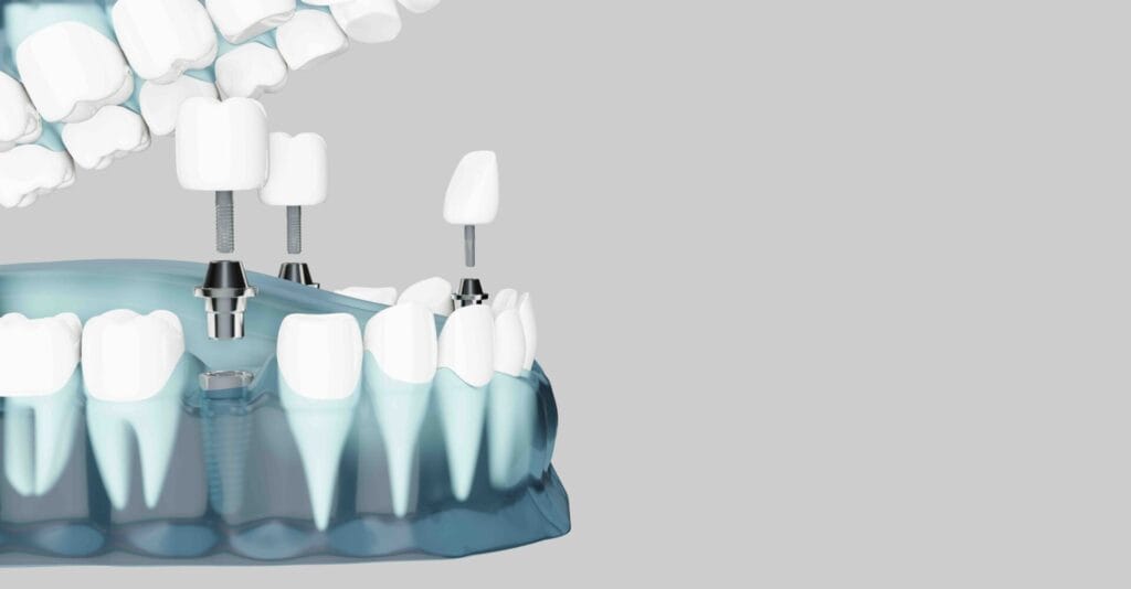Come Si Effettua un trattamento implantare 1 Come si effettua un impianto dentale