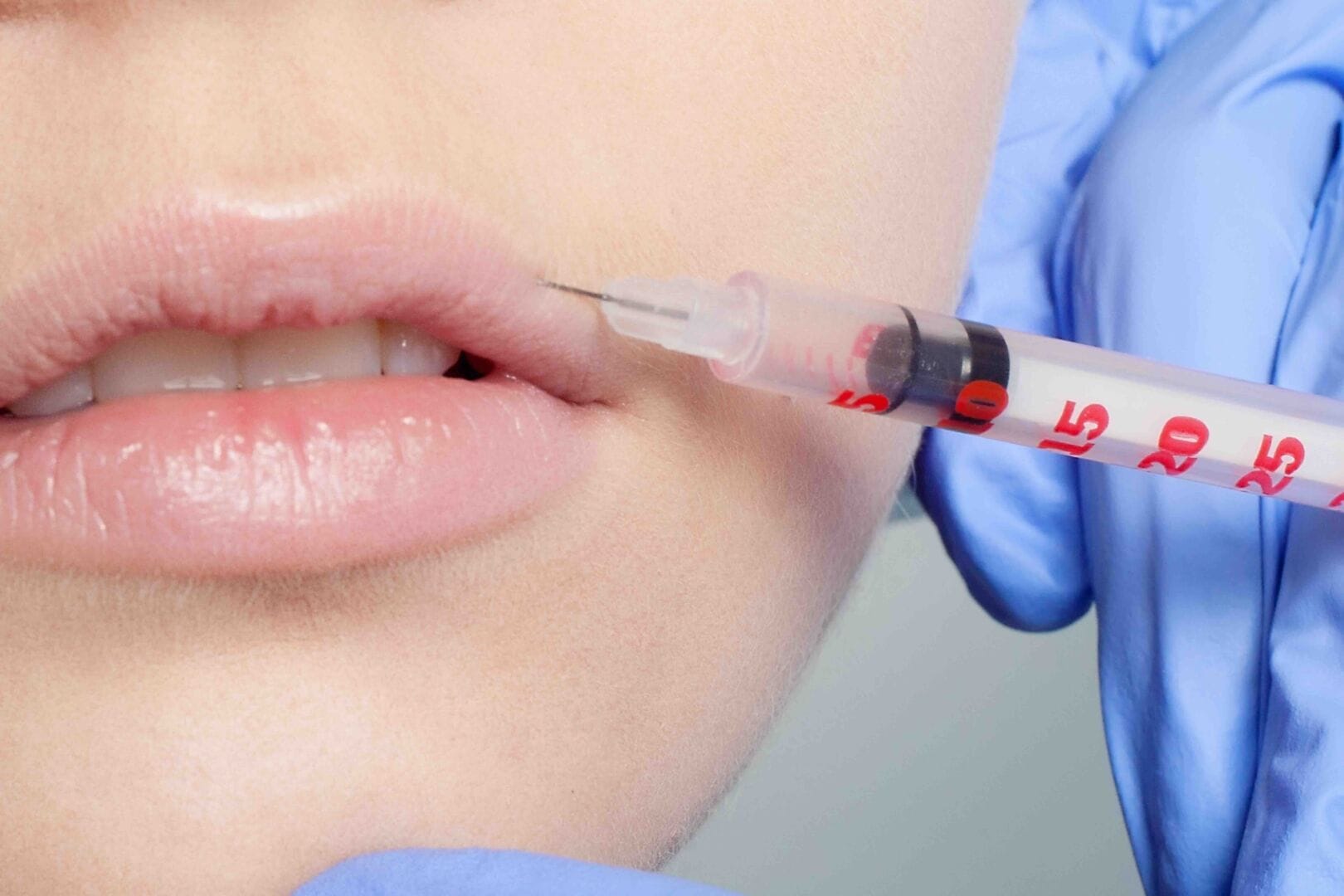 Filler alle labbra - Medicina estetica a Savigliano - studio dentistico a Savigliano
