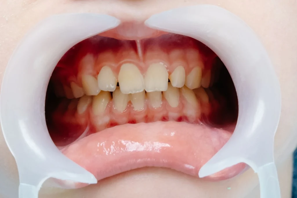 Ho paura che la gengivite diventi parodontite 2 paura che la gengivite diventi parodontite