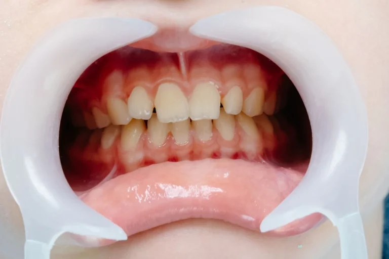 paura che la gengivite diventi parodontite